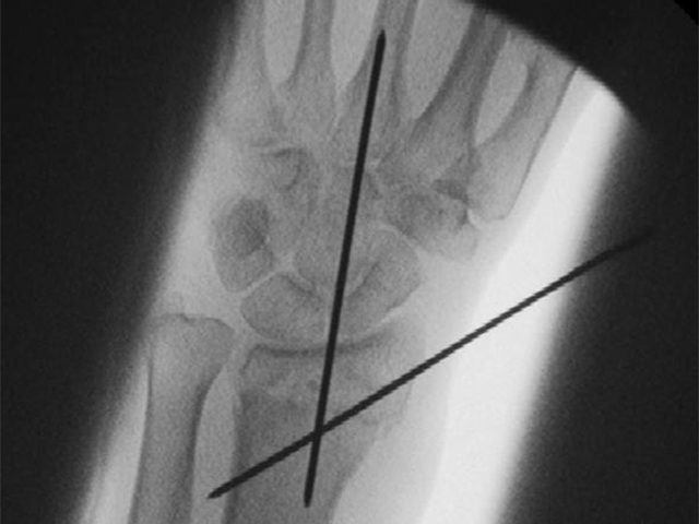 13_Fracture-with-wires